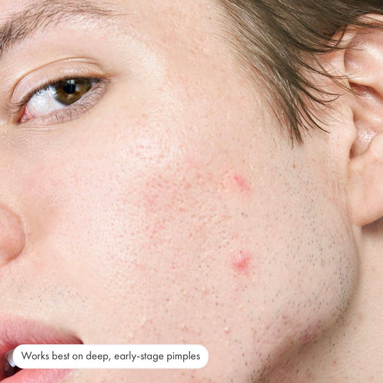 Hero Cosmetics Micropoint for Blemishes (8 Patches). هيرو كوزمتيكس ميكرو بوينت للعيوب (8 لصقات) - Princess Cosmetics Qatar