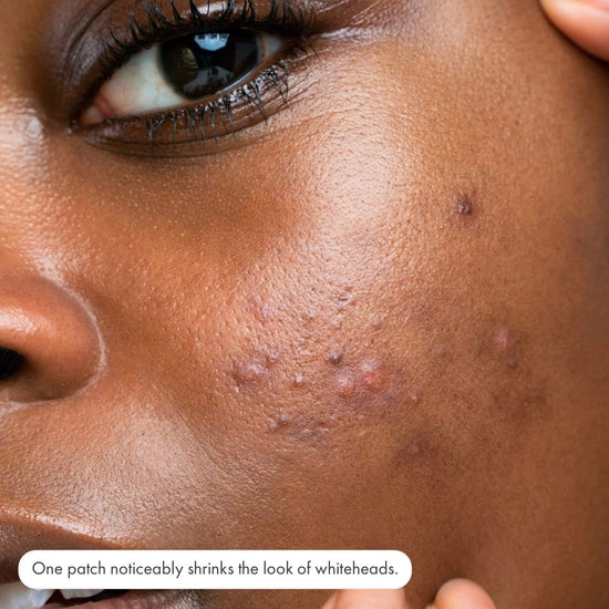 Hero Cosmetics Mighty Patch Invisible+ (39 Patches). هيرو كوزمتيكس مايتي باتش إنفيزيبل+ (39 رقعة) - Princess Cosmetics Qatar