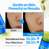 Numbuzin Zero Blemish Clarifying 2% Sulfur Cleansing Foam 150ml نومبوزين زيرو بليميش رغوة تنظيف منقية للبشرة بالكبريت 2%