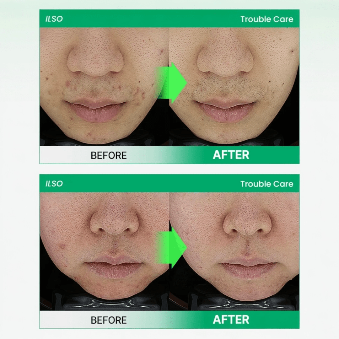 ilso No Problem Spot Softener 150g منعم البقع بدون مشاكل - Princess Cosmetics Qatar