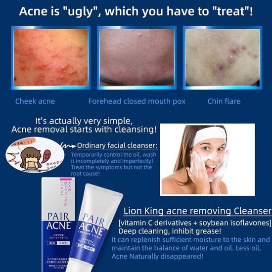 Lion Acne Pair Creamy Foam 80g ليون لعلاج حب الشباب، كريم رغوي مزدوج - Princess Cosmetics Qatar