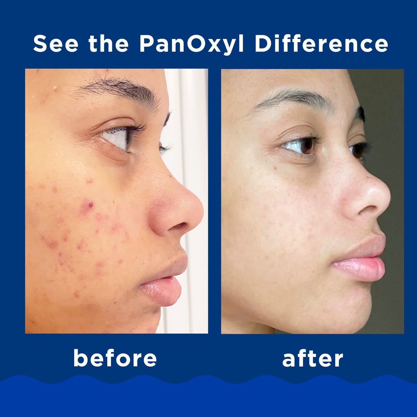 PanOxyl Acne Foaming Wash Benzoyl Peroxide 10% Maximum Strength 156g. PanOxyl حب الشباب رغوة غسول البنزويل بيروكسايد 10 ٪ أقصى قوة - Princess Cosmetics Qatar